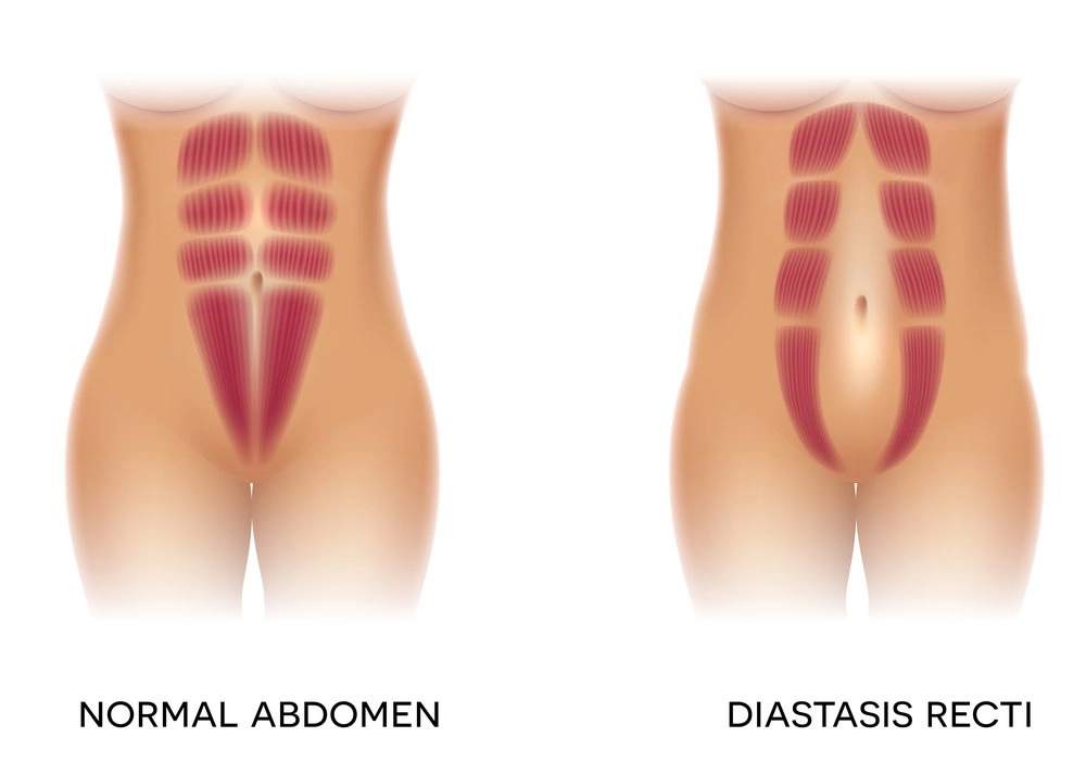 diastasi retti